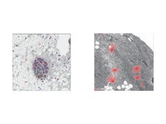 Organizzazione spaziale e tessuto-specifica della senescenza cellulare (un processo in cui le cellule danneggiate o invecchiate smettono di dividersi, ma rimangono attive). (Fonte: The Lancet Digital Health)